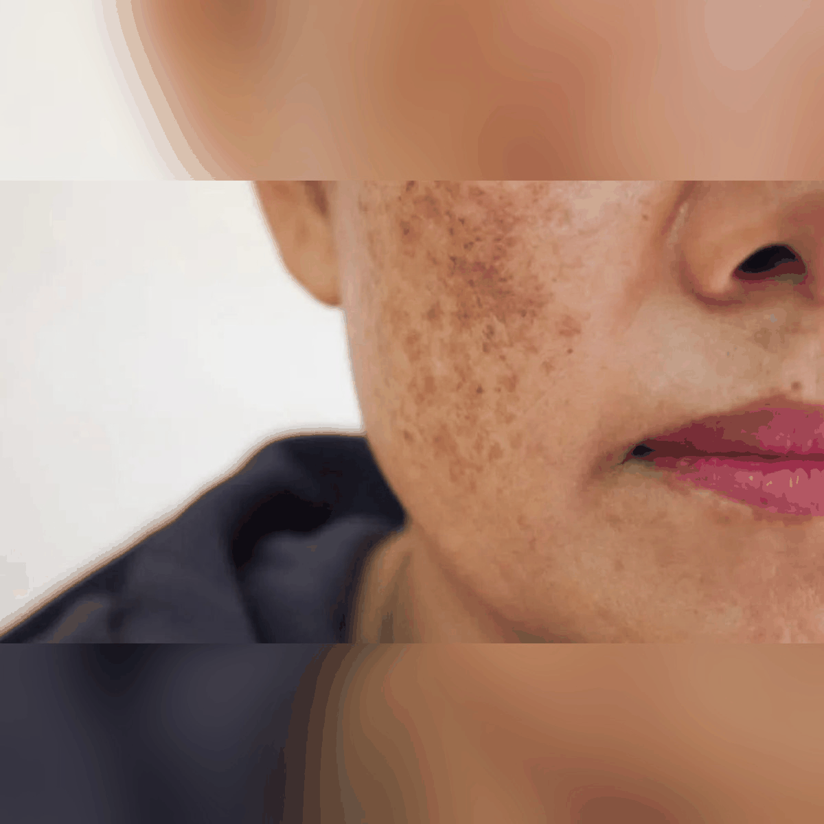Have melasma? Here's what you can do about it
