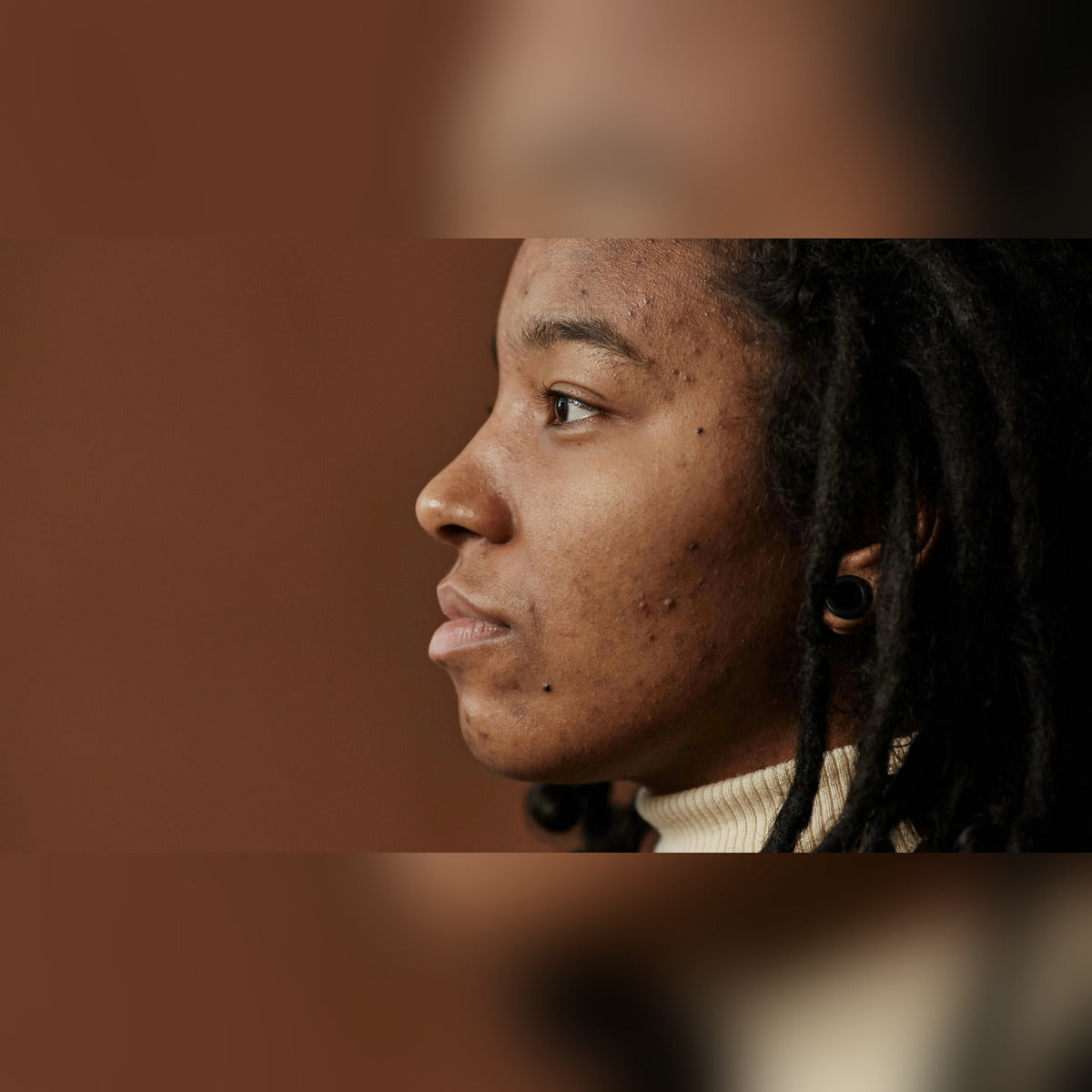 Is Your Acne Hormonal? Here's How to Tell