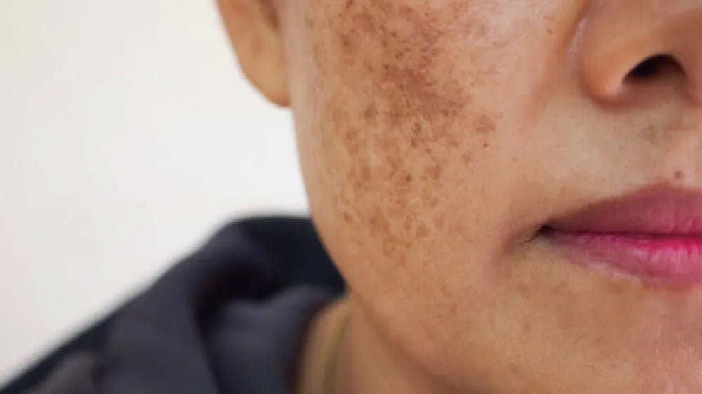 Have melasma? Here's what you can do about it