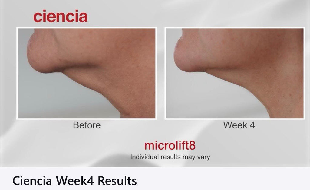Microlift8 Before and After - Chin Jawline Week 4 Results