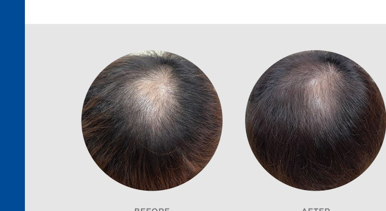 EXO-GROW progress example after 4 treatments and homecare