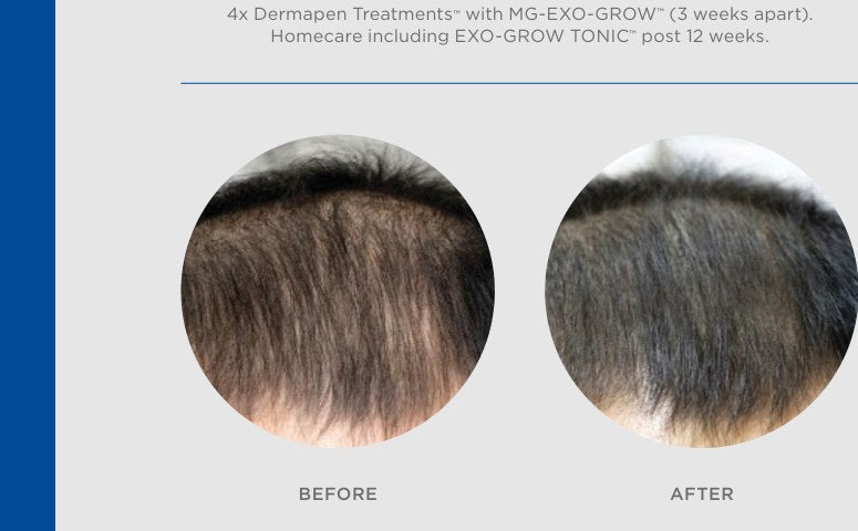 EXO-GROW progress example after 3 treatments and homecare