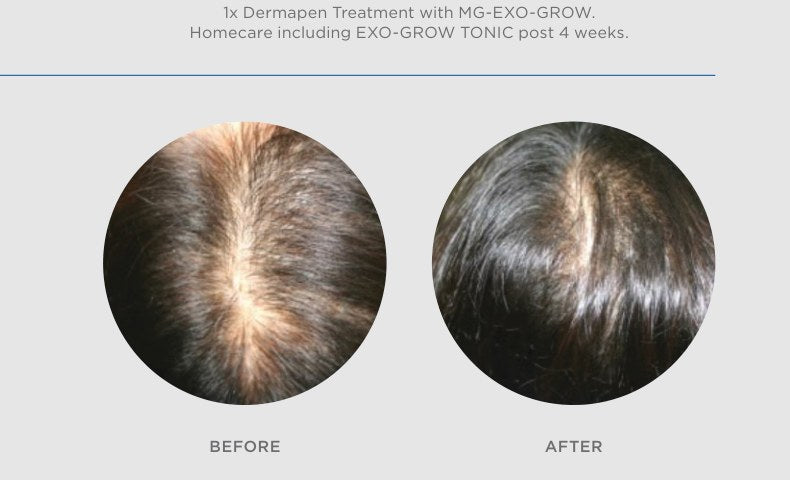 EXO-GROW progress example after 2 treatments and homecare